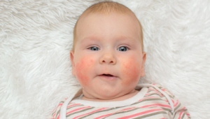 Почему возникают красные щеки у ребенка