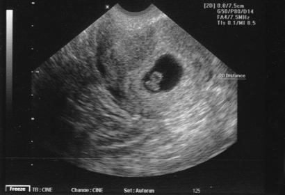Эмбрион на снимке