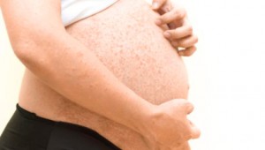 Краснуха при беременности: симптомы и последствия для плода