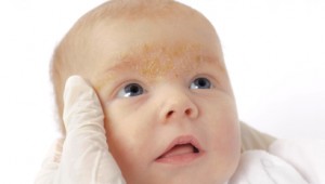Себорейный дерматит у детей: как выглядит, особенности лечения