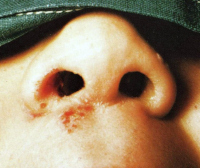 Инфекция в пазухе носа