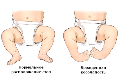 Деформация стоп у новорожденного