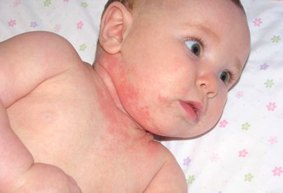 Сыпь на щечках у месячного ребенка