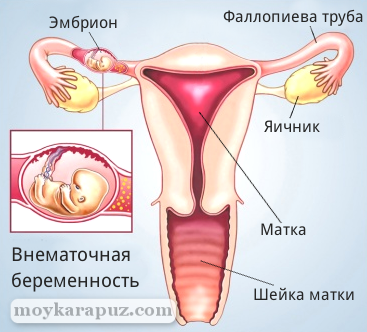http://moykarapuz.com/up/files/images/vnematochnaya-beremennost.png